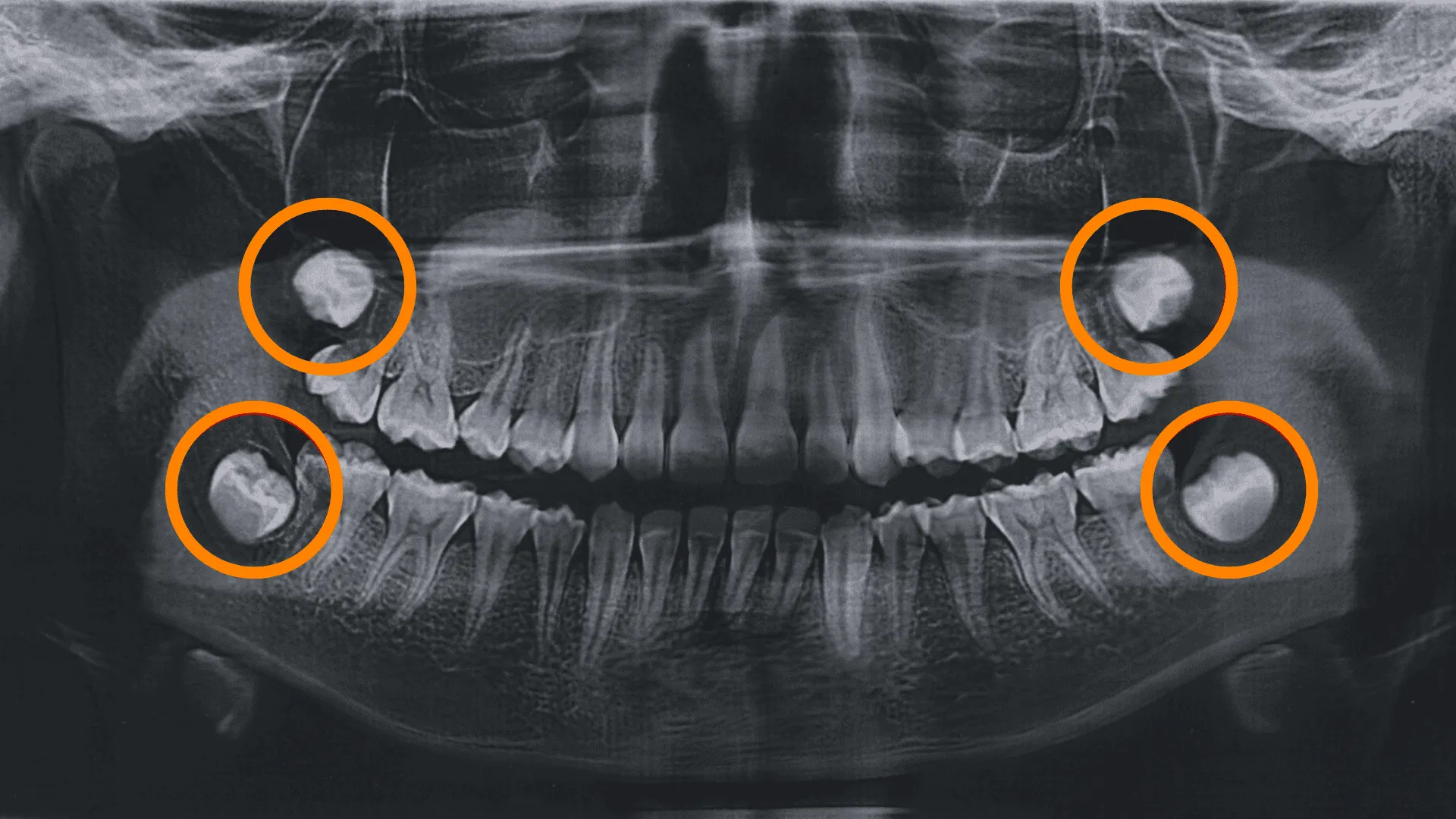 Wisdom Teeth wisdom teeth