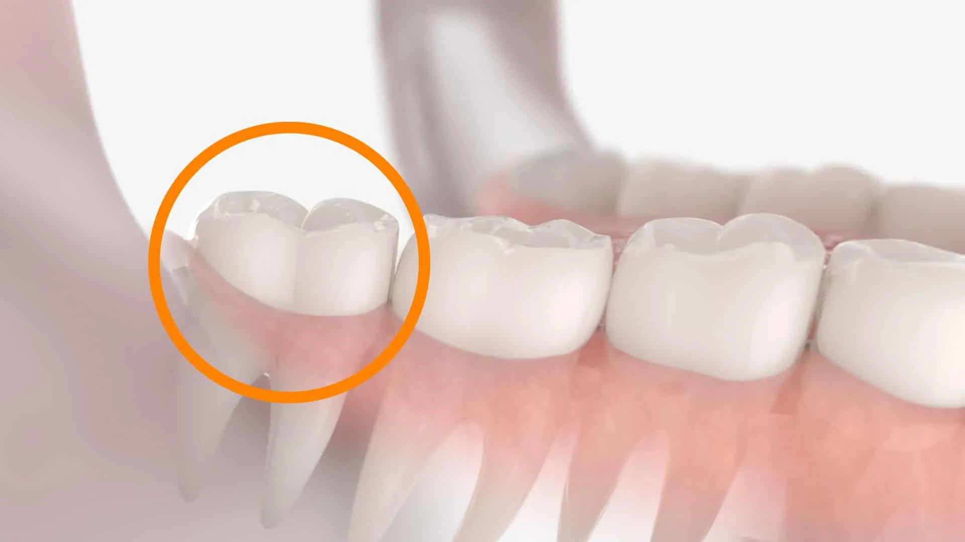 Wisdom Tooth Illustration wisdom tooth illustration